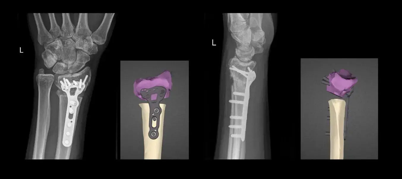 Patient-specific surgical part 3D printed using SLS technology